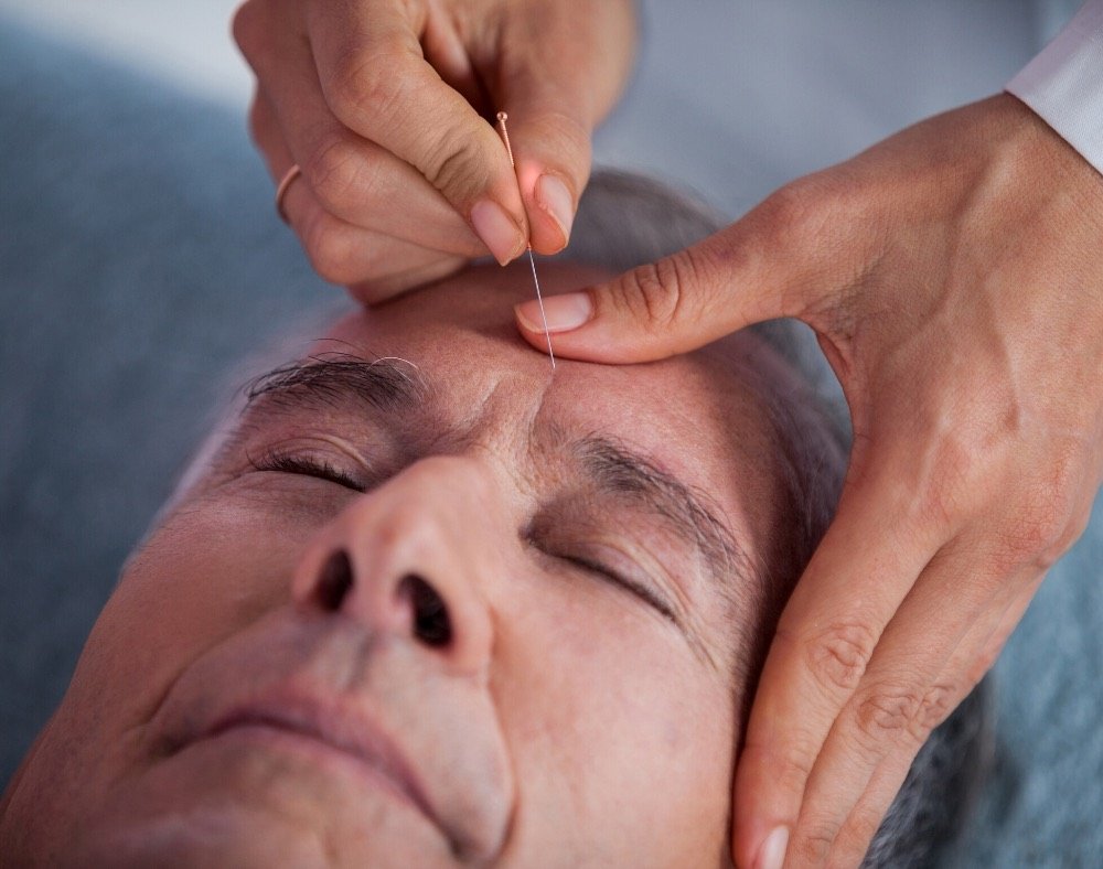 how-acupuncture helps improve memory of persons with dementia