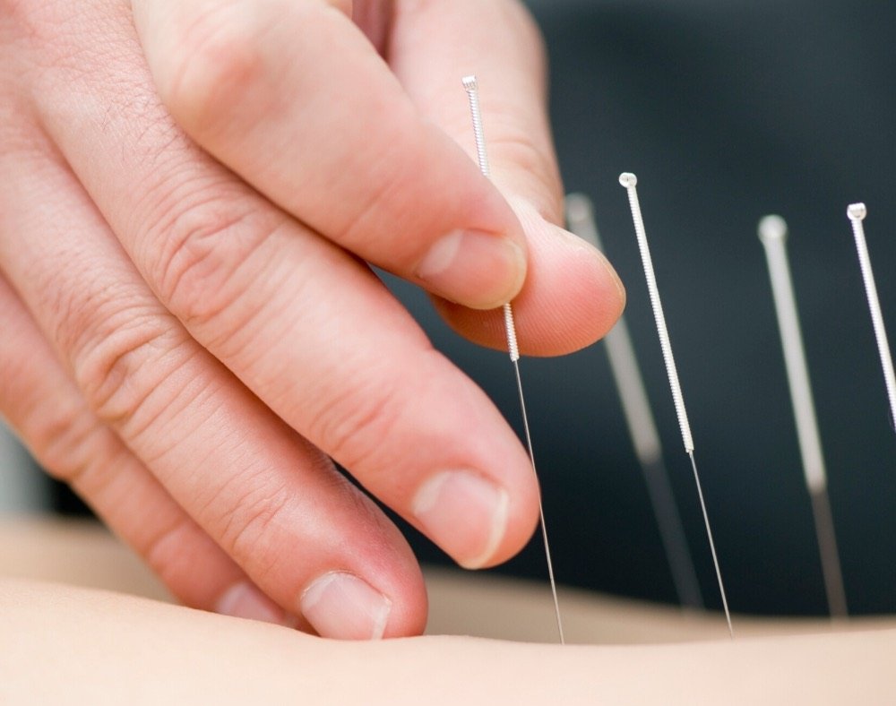 what is acupuncture