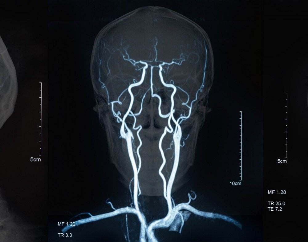 genetics of vascular dementia