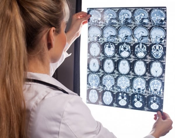 Can An Mri Detect Dementia