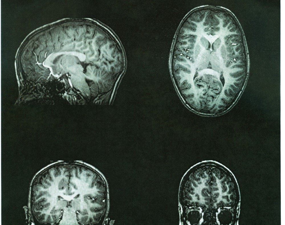 Can an MRI Detect Dementia? - ReaDementia