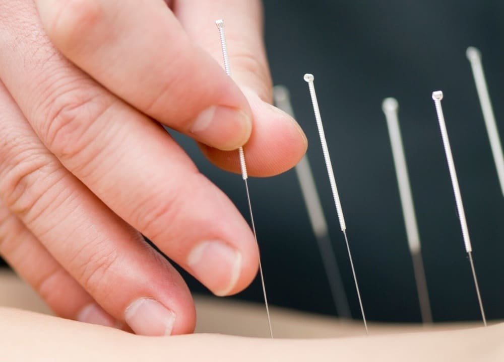 acupuncture and dementia