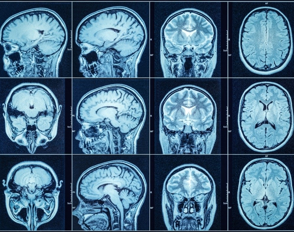 can-a-ct-scan-show-dementia-is-mri-better-readementia