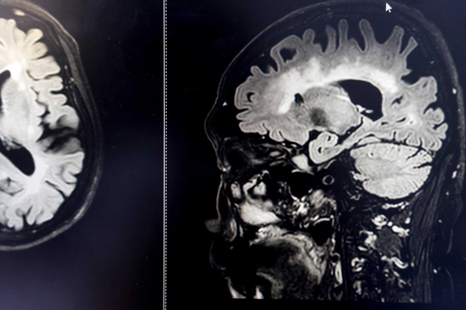 Brain scan showing changes associated with Alzheimer’s disease
